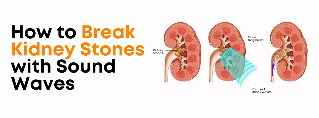 How to Break Kidney Stones with Sound Waves
